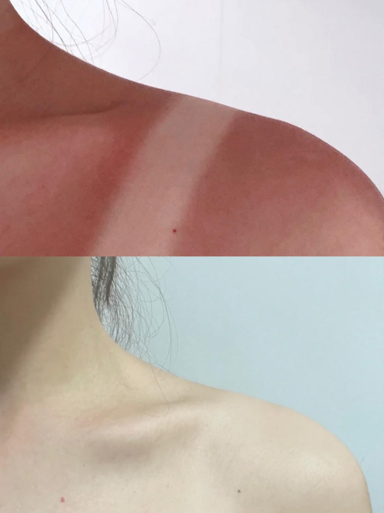 皮肤被晒脱皮了如何修复,晒后皮肤如何修复