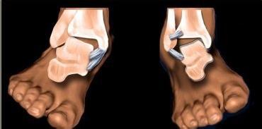 踝关节扭伤包扎,踝关节扭伤热敷