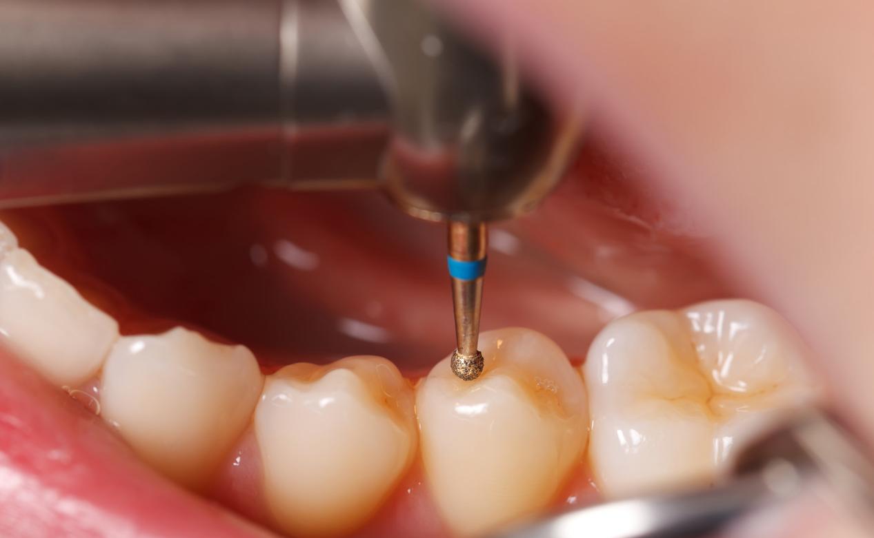 洗牙到底是伤害牙齿还是保护牙齿,洗牙对牙齿伤牙吗