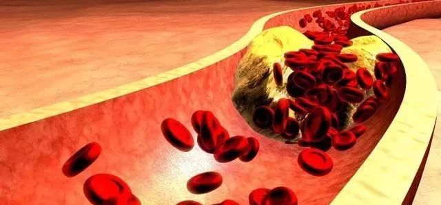 动脉粥样硬化最大危害,动脉硬化最有效的预防方法是什么