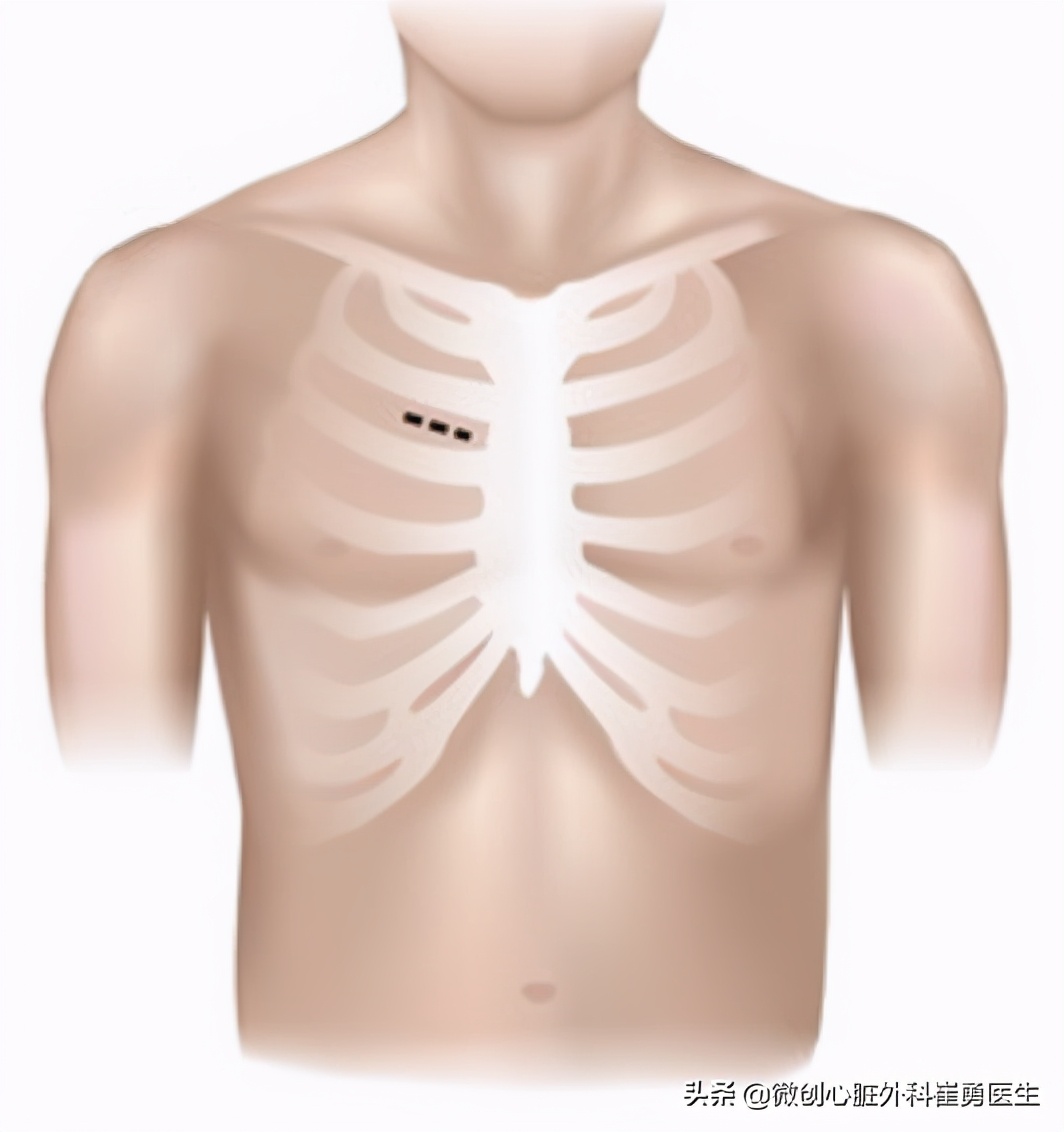 浙江省人民医院做心脏手术如何,浙江人民医院微创心脏手术