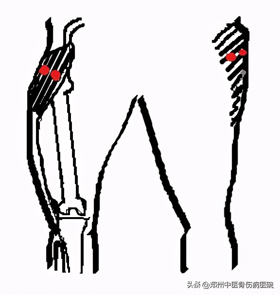 走路阔筋膜张肌痛如何治疗,髋关节周围肌肉筋膜如何放松