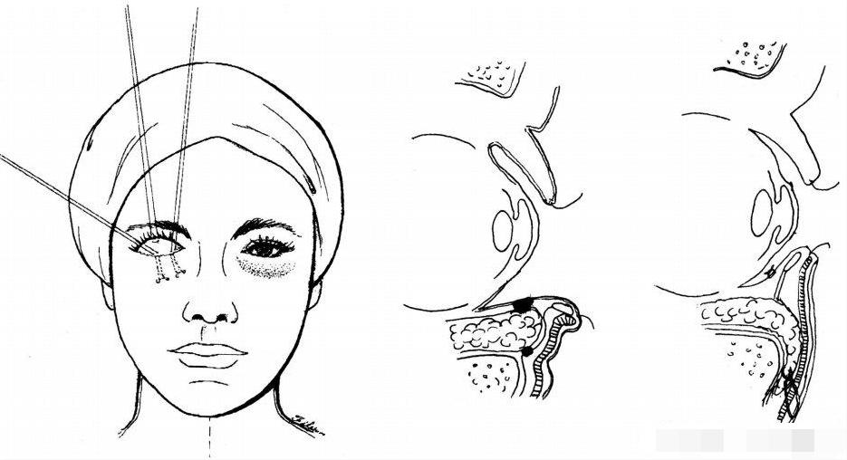 什么是眶隔脂肪释放？为什么很多医生都建议用这个方法去眼袋？