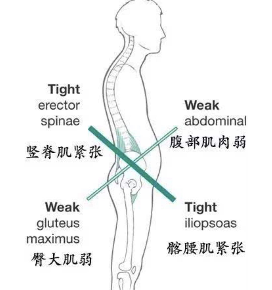 骨盆前倾引起的腰痛如何缓解,如何缓解久坐带来的腰酸腰痛