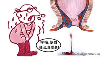 痔疮在外面不得劲怎么办,痔疮收缩自如