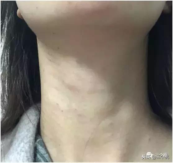 医美去颈纹全过程,去颈纹医美过程