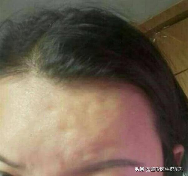 脂肪填充不要轻易尝试,脂肪填充面部不对称怎么办