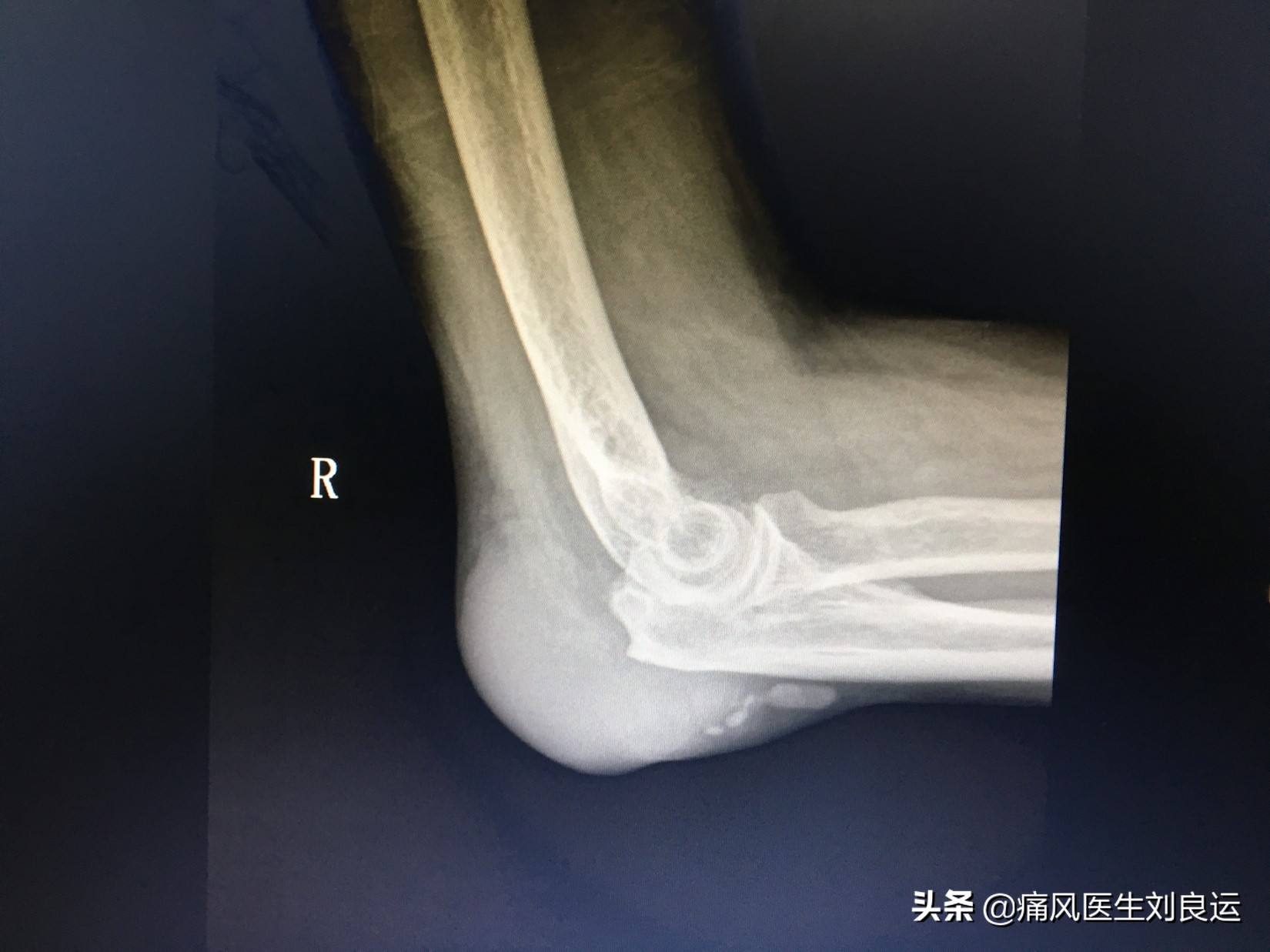 尿酸正常了可以手术取痛风石吗,痛风石可以做手术取掉吗