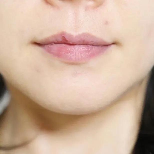 十年战痘肌自救指南,十年痘肌怎么抗痘