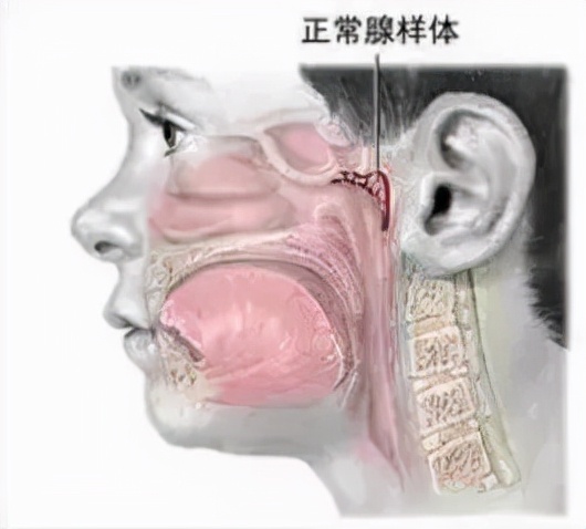快速根治打鼾专利,打呼噜最新研究成果