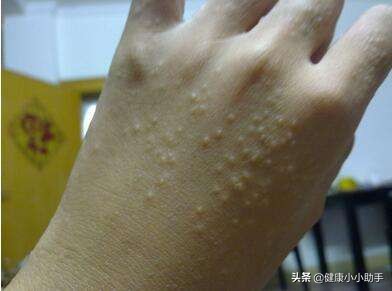 手指到夏天就会有水泡是怎么回事,夏天起小水泡用什么药