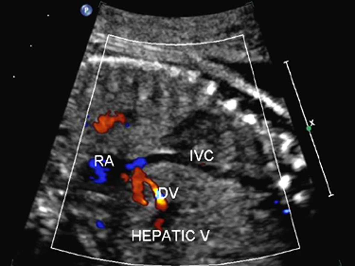 胎儿超声心动图报告解读,胎儿彩色多普勒超声心动图