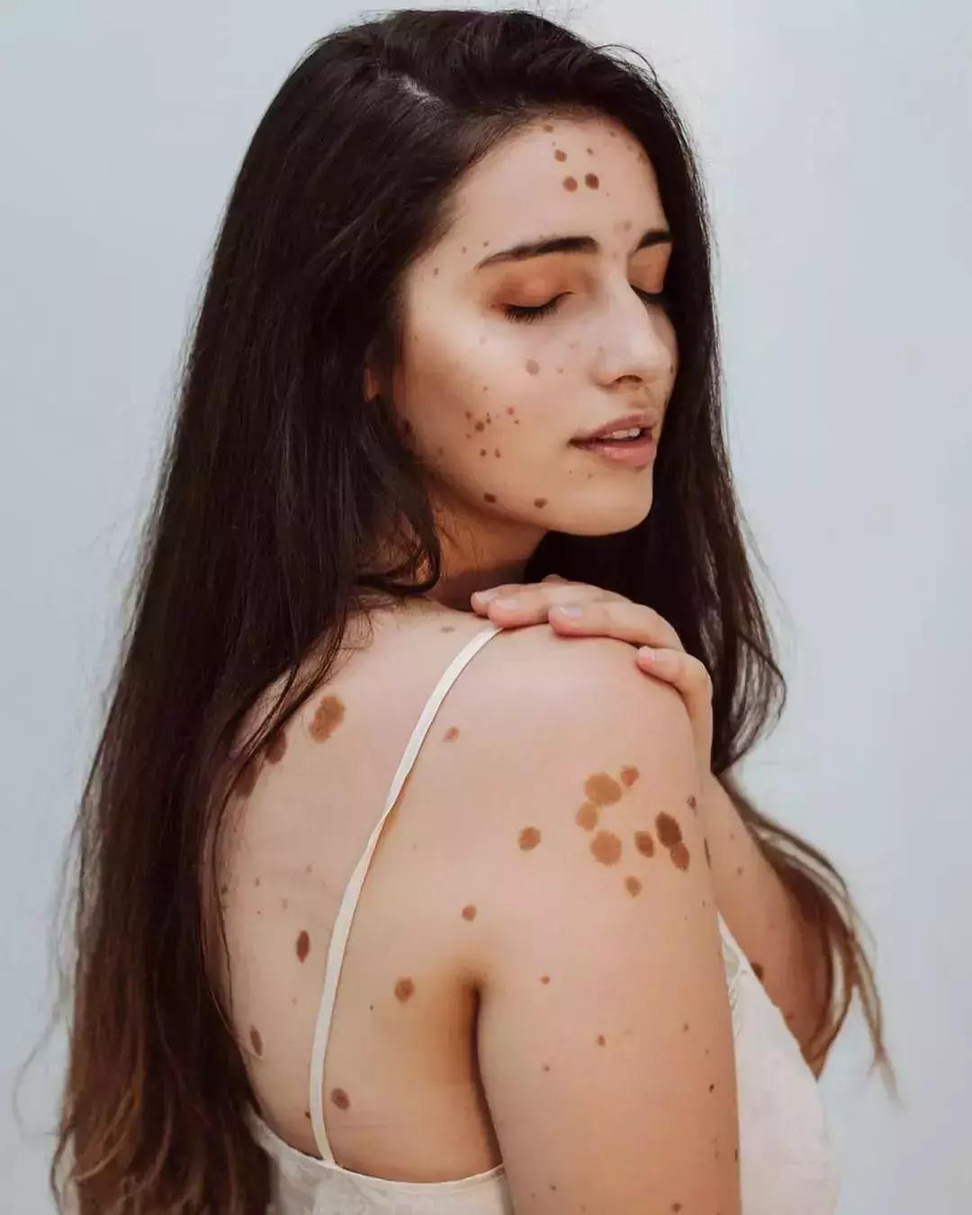 全身黑斑被骂“斑点狗”，身高160的她却成为最美超模…