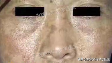 褐青斑是雀斑样痣吗,脸上太田痣怎么祛斑