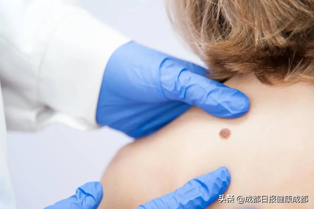 黑痣黑色素瘤检查挂什么科,黑痣切除了就可以防恶变