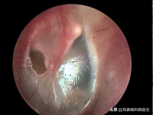 外伤鼓膜穿孔发炎怎么治,耳鼓膜穿孔怎么治