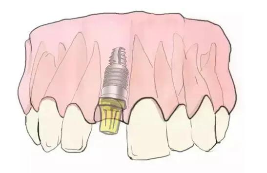 传统的种植牙和即刻种牙的区别,什么是种牙方法