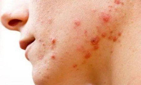 祛痘误区痘痘为何反反复复,祛痘千万不要用手挤