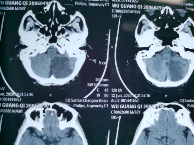 急性脑梗死支架取栓用开颅吗,急性脑梗死支架取栓视频