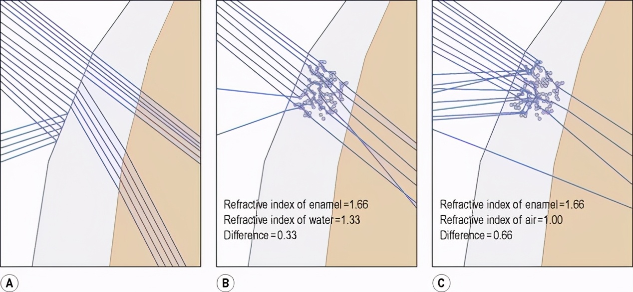 牙齿脱矿了如何补救,牙齿脱矿了怎么治