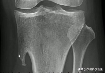 不同性别患者，同因外伤检查相同部位，发现相同位置的同一疾病？