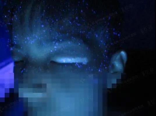 白癜风有不会扩大的吗,白癜风会导致视力障碍吗