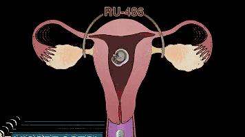 堕胎到底有没有恶果,堕胎真的那么可怕吗