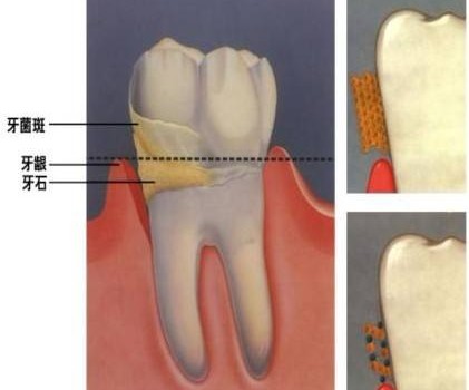 牙齿臭有牙结石怎么去除,牙黄有口臭有牙结石怎么办