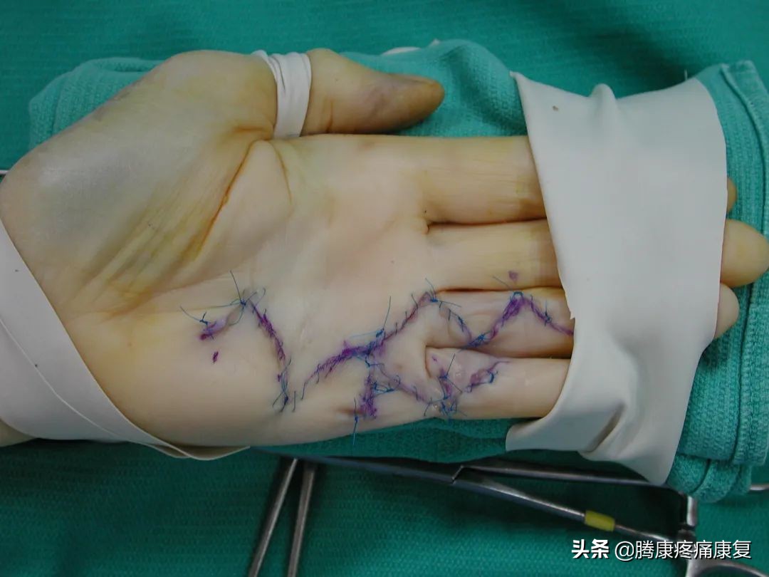 手掌腱膜挛缩不手术会怎样发展,头帽状腱膜挛缩症最新治疗方法