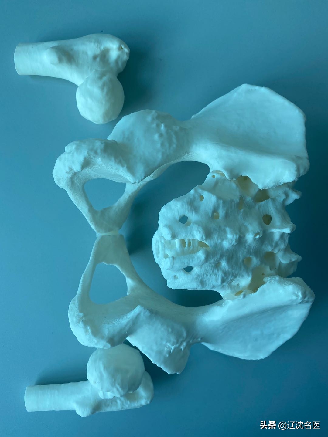 股骨头坏死置换后遗症,股骨头坏死吃止痛片有用吗