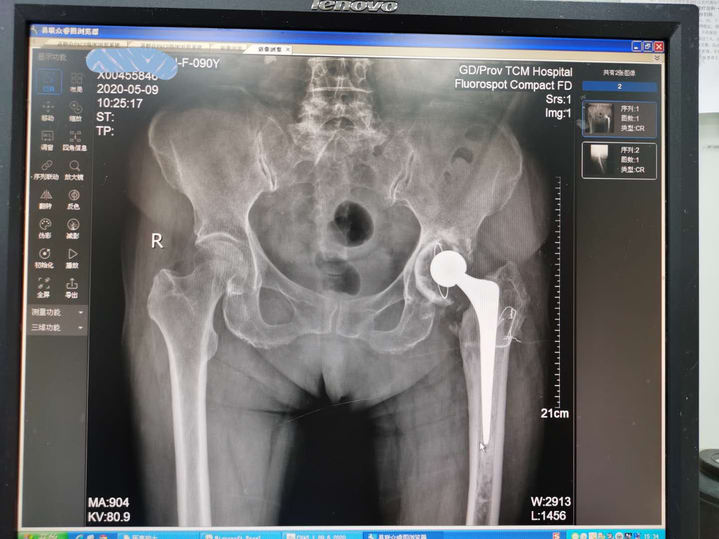90岁老人髋关节置换术死亡率多高,90岁老人微创髋关节置换技术