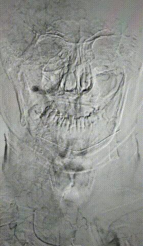 脑卒中发生时自己怎么自救,脑卒中急救黄金1小时