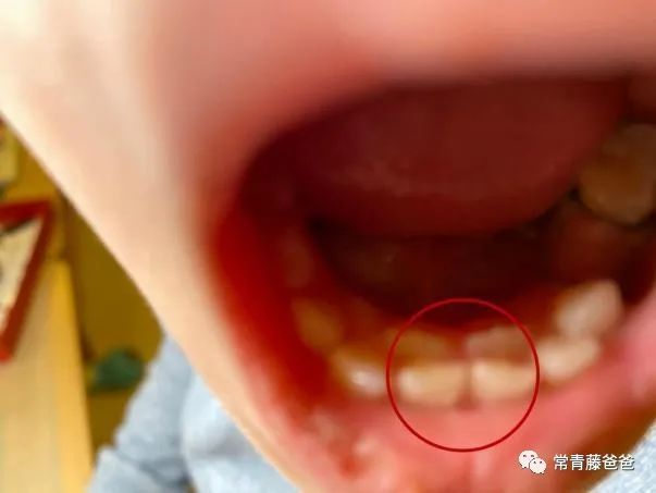 5岁双排牙最佳解决方法,宝宝换牙期长出双排牙需要拔掉吗