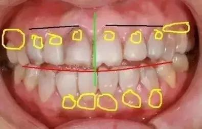 烤瓷牙可以解决牙齿不齐问题吗,烤瓷牙能修复吗