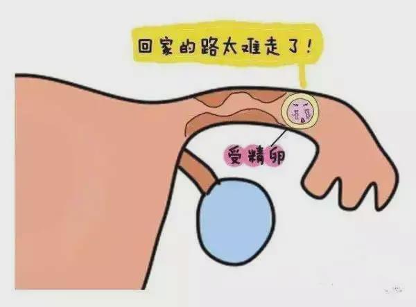 女子宫外孕,宫外孕大出血死亡事件