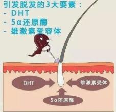雄性激素旺盛的脱发植发有用吗,雄性脱发不植发吃药能好吗
