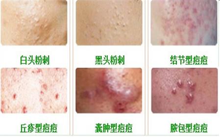 脸上的痘痘怎么解决干货,彻底根治脸上痘痘的干货