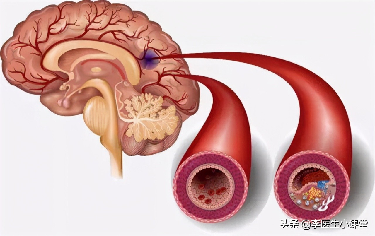 48岁心肌梗死不支架可以吗,35岁得心梗没放支架恢复很好