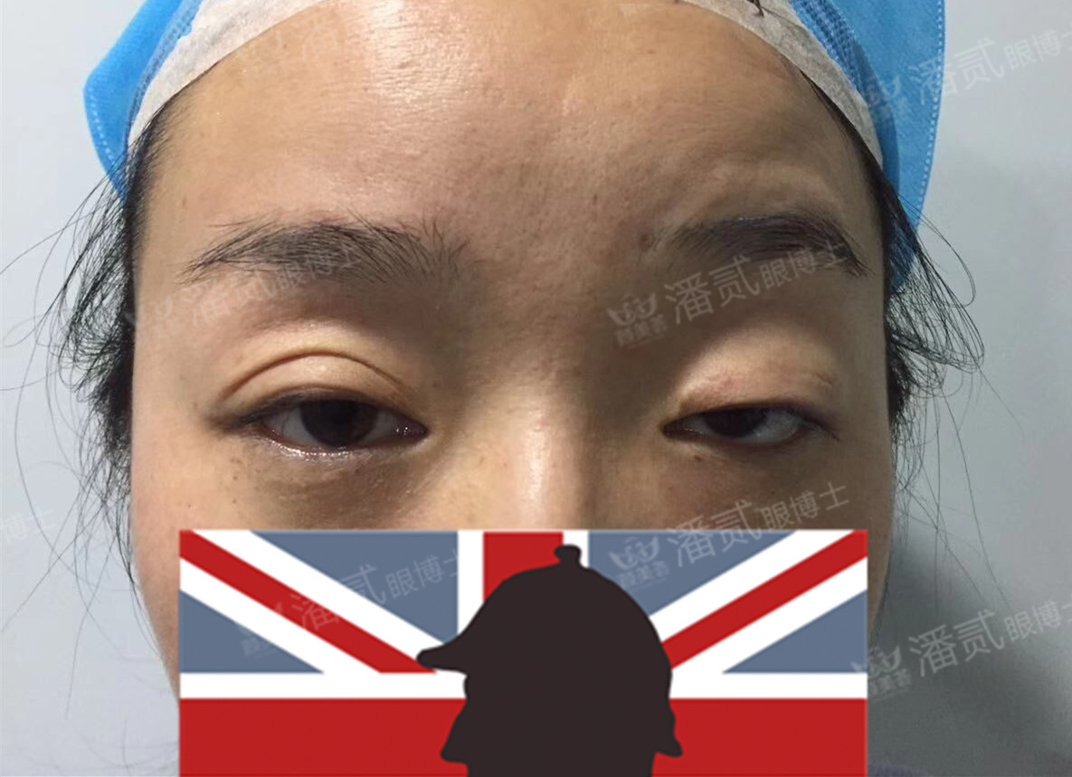 提肌矫正失败的表现眼皮睁不开,做完提肌眼睛前半段下垂