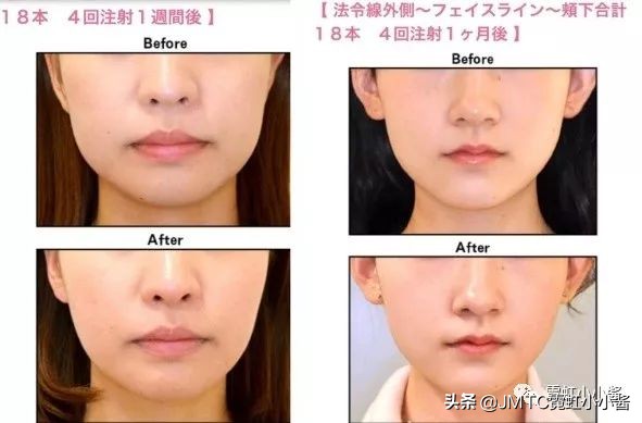 日本小姐姐针灸瘦脸视频,小姐姐打瘦脸针视频