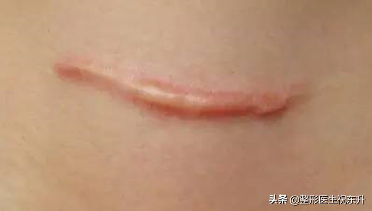 想做眼袋手术做哪种好,去眼袋手术会有疤痕吗