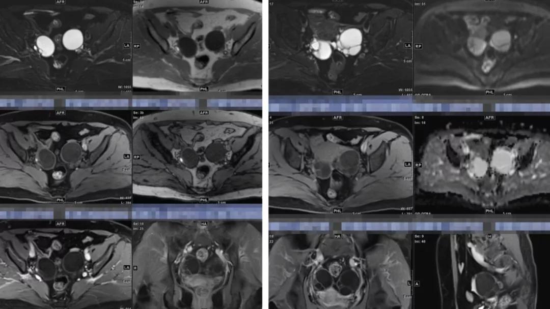 卵巢原发肿瘤的分析思路