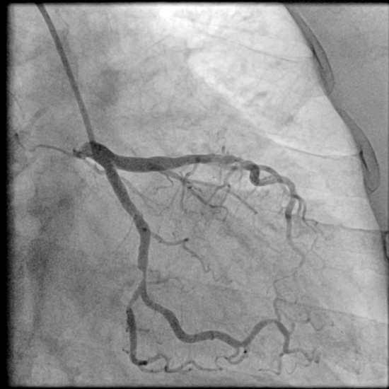 做心脏造影会不会伤害心脏,做心脏造影会不会伤到血管