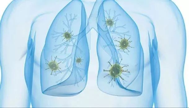 新冠肺炎痊愈后怎么护肺,请问专家肺炎吃什么药比较好