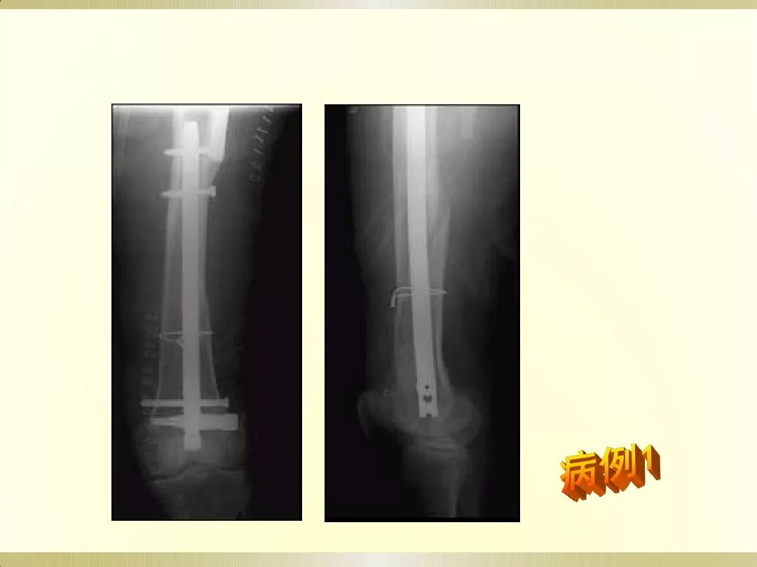 骨科x光片读片技巧,放射科骨科读片教程