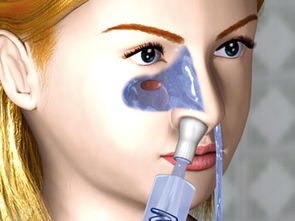 五官理疗仪鼻炎,针灸治疗过敏性鼻炎有效吗