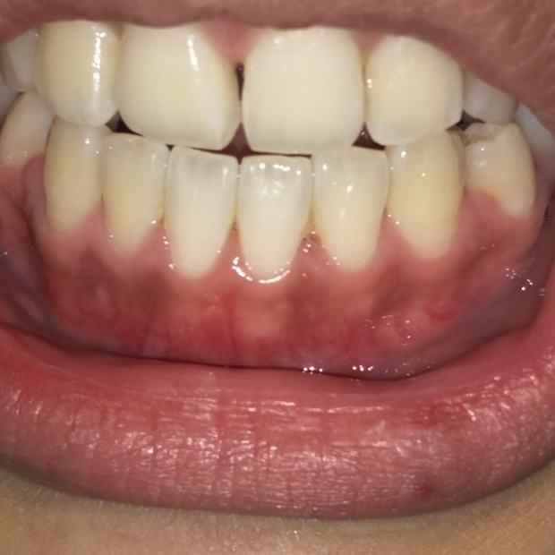 牙齿为何会变薄,牙齿为什么会牙龈萎缩