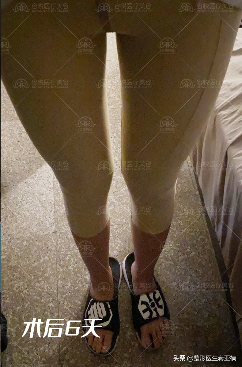 吸脂塑形造就婀娜身材,瘦人美容