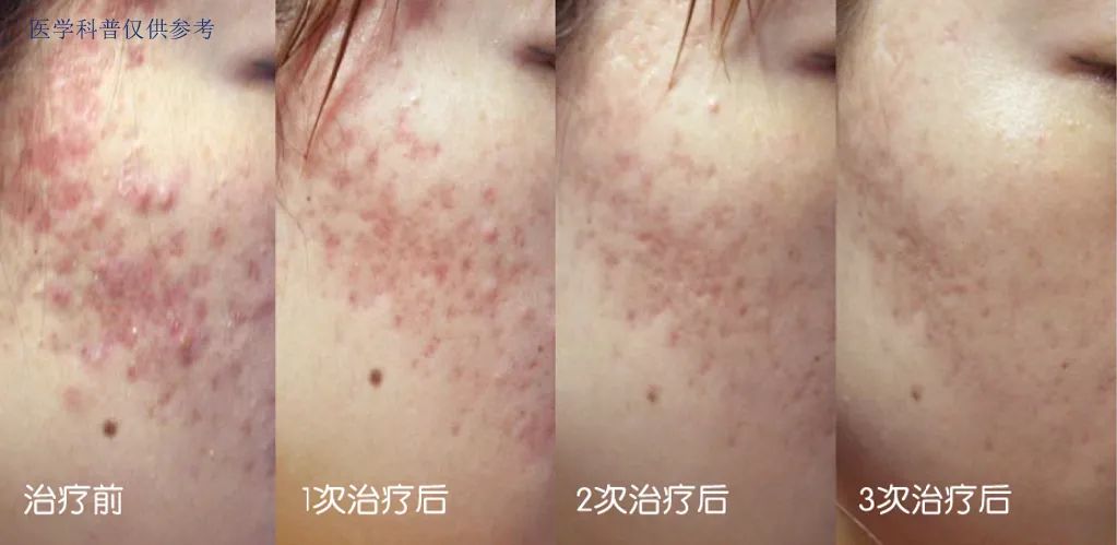 明星都在做的医美,光电光子嫩肤