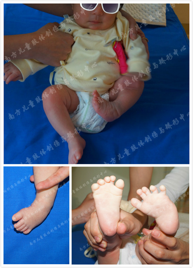 严重马蹄内翻足新生儿,先天性马蹄内翻足成年后能治疗吗